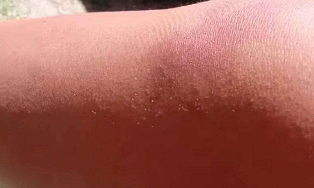 Carnaval en Ayacucho: una bailarina lesionada por un tarro de espuma en pleno desfile