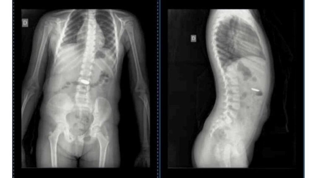 Chascomús: una madre denunció que debió consultar a 7 médicos para constatar que su hija se había tragado una pila